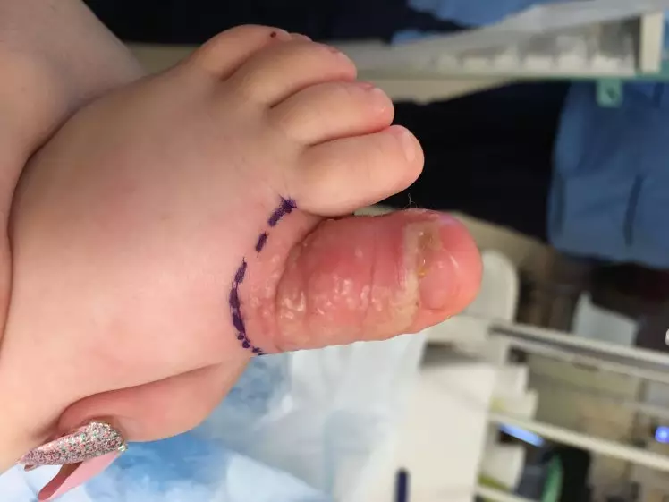 Toddler's infected toe