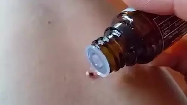 Viral Video Showing How To Remove A Tick Could Actually Give You Lyme Disease
