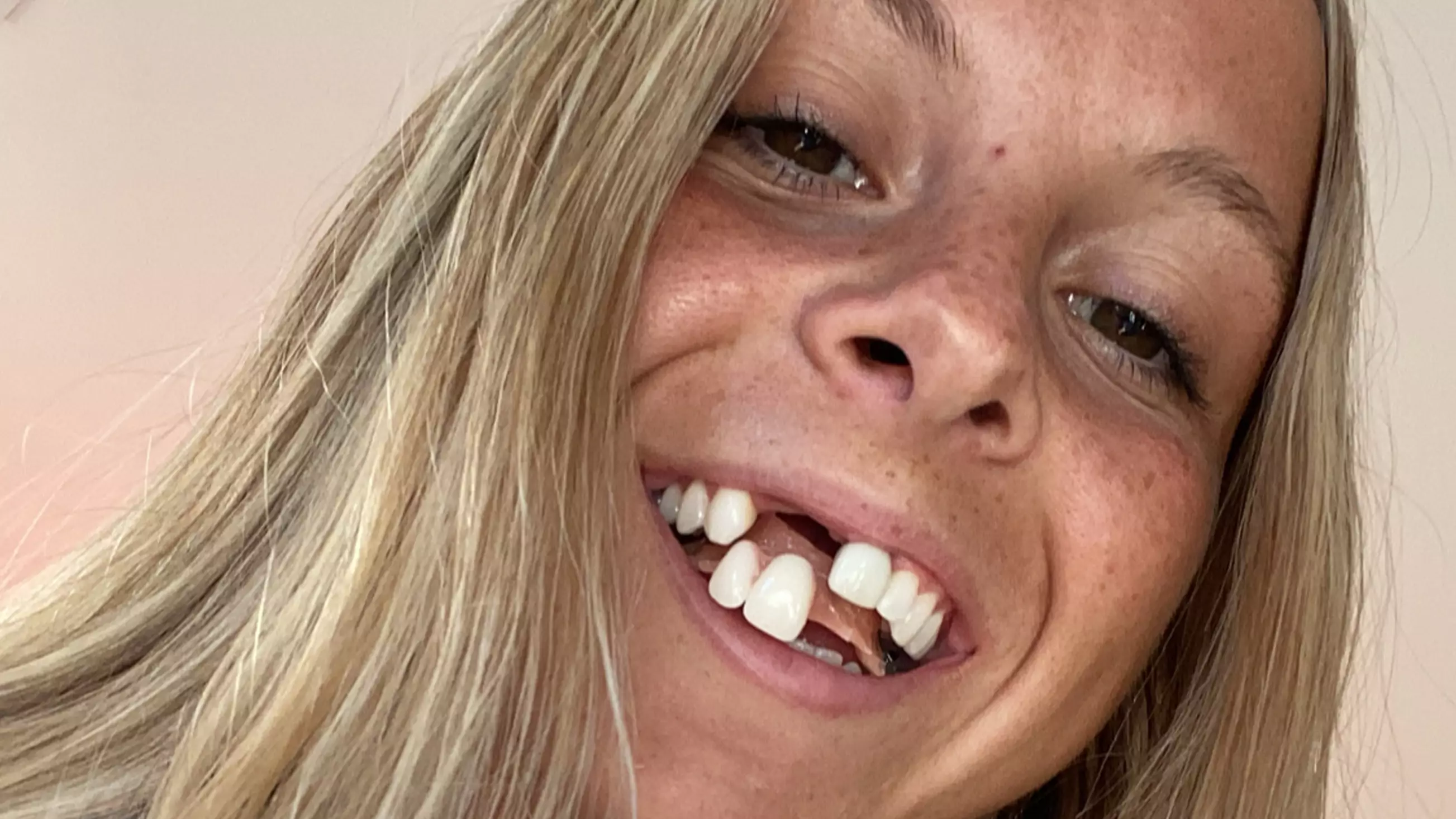 25-Year-Old Influencer Says Dentures Have Negatively Affected Her Love Life