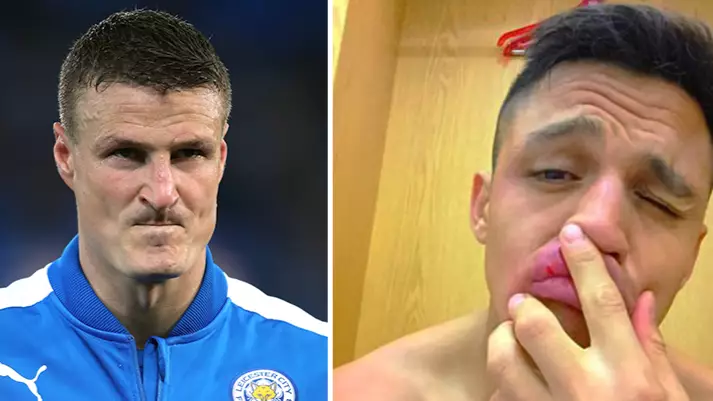 Robert Huth Uploads Picture Of Hilarious Injury Sustained During Arsenal Game