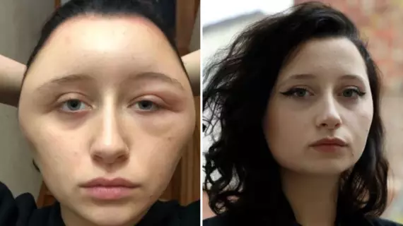Woman's Head Swells To Twice Its Size After Hair Dye Allergic Reaction