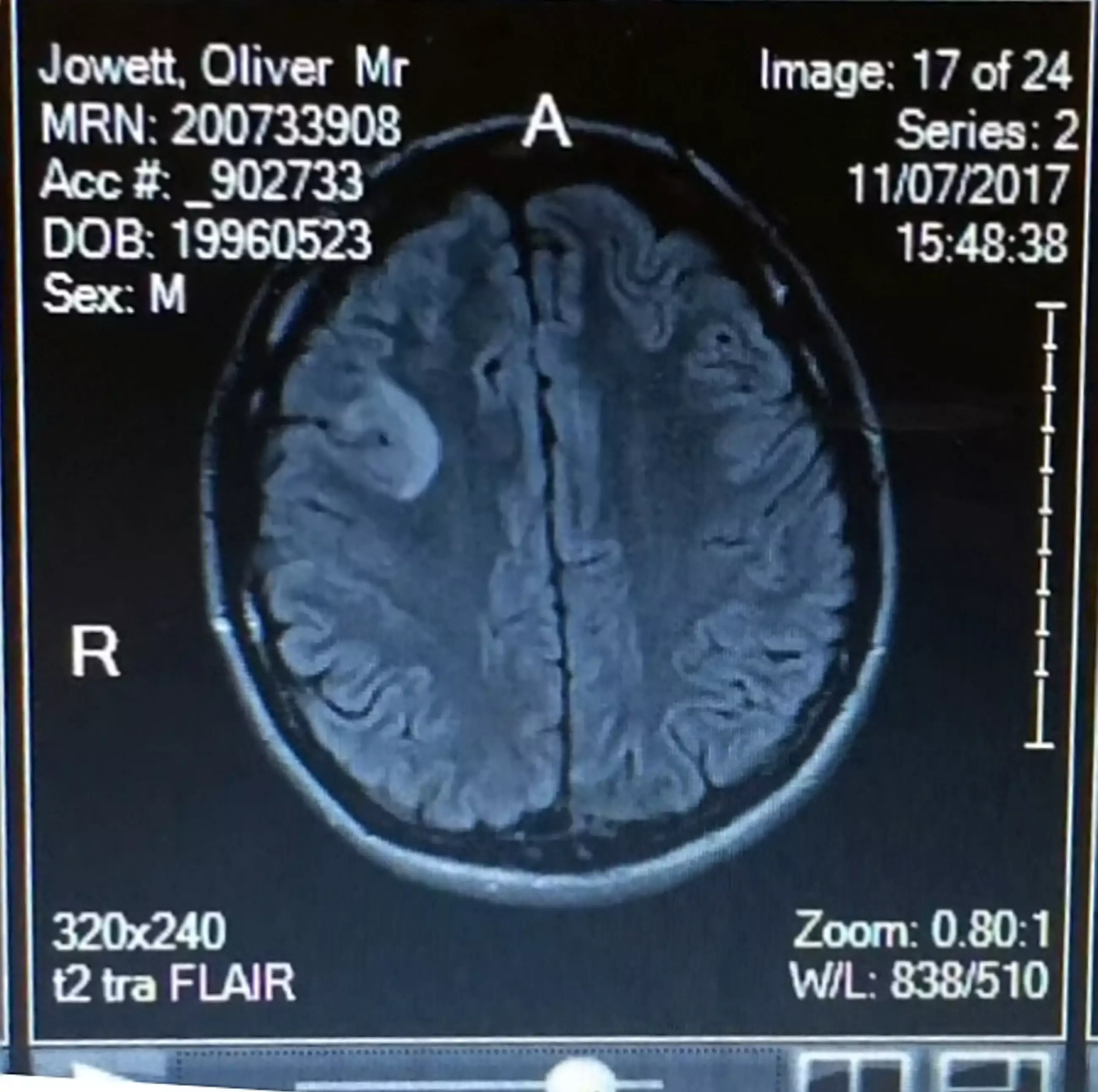 Ollie's brain tumour scan.