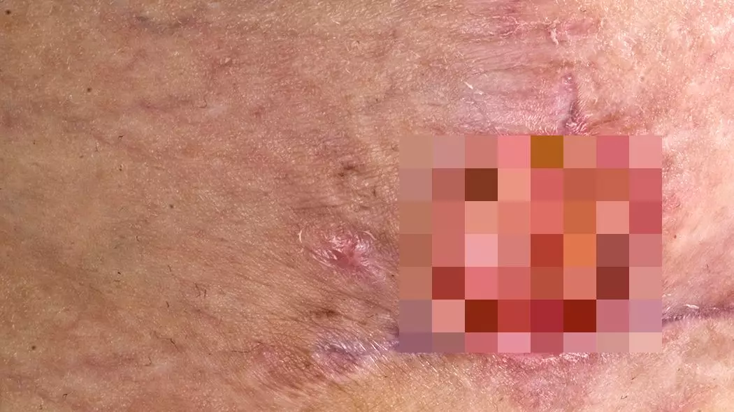 Inner Melbourne Put On Alert After Skin-Eating Bacteria Discovered For The First Time