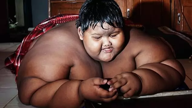 'World's Fattest Boy' Loses Half His Body Weight After Life-Saving Surgery