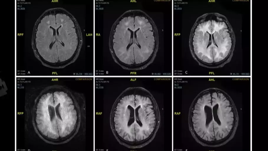 Doctors Release Images Of Brain Scan Showing The Effects Of Cocaine
