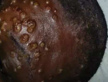Monkeypox belongs to the same family of viruses as smallpox, but causes a milder infection.