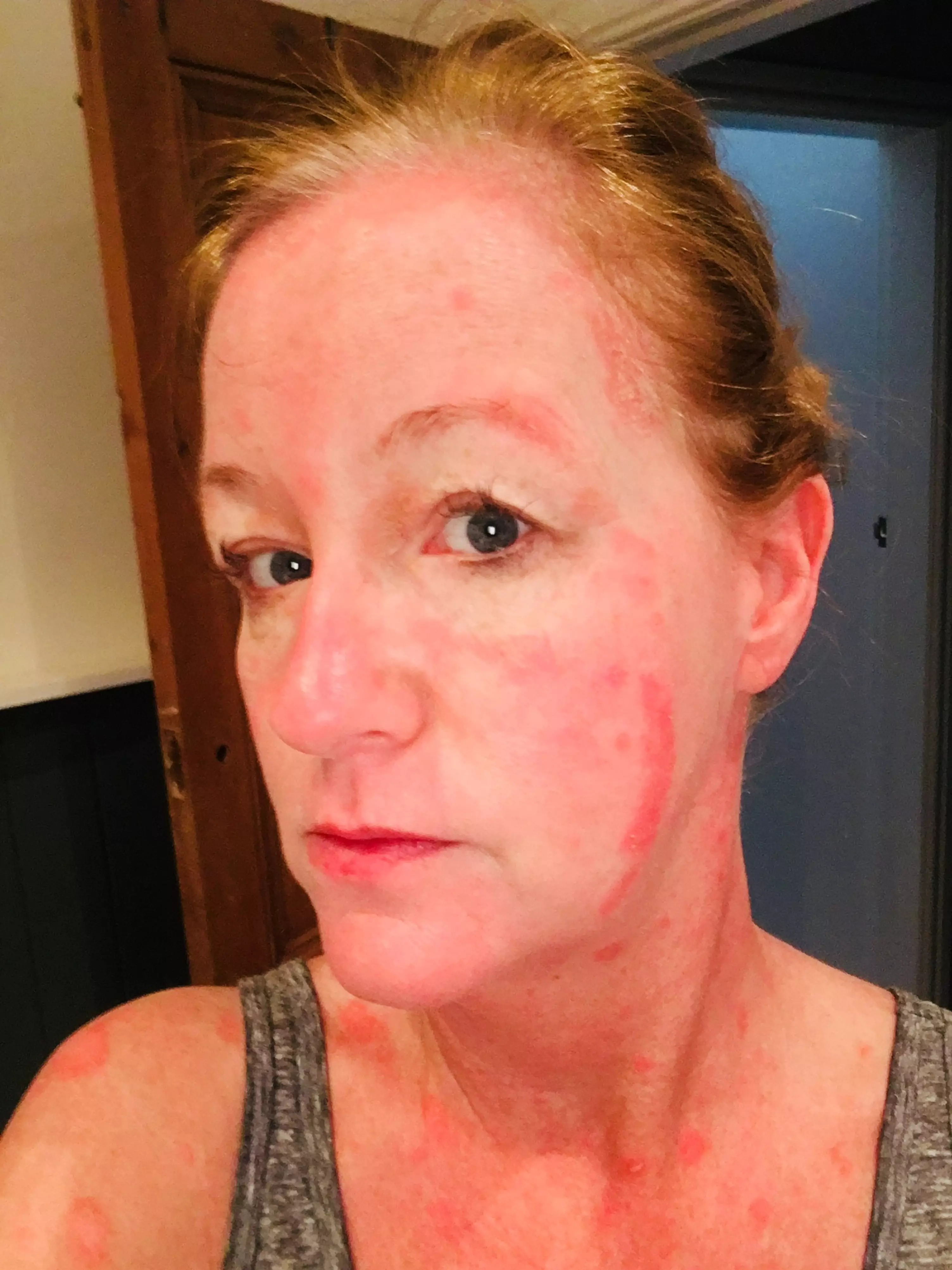 The Preston native explained how the skin condition hindered her daily life.