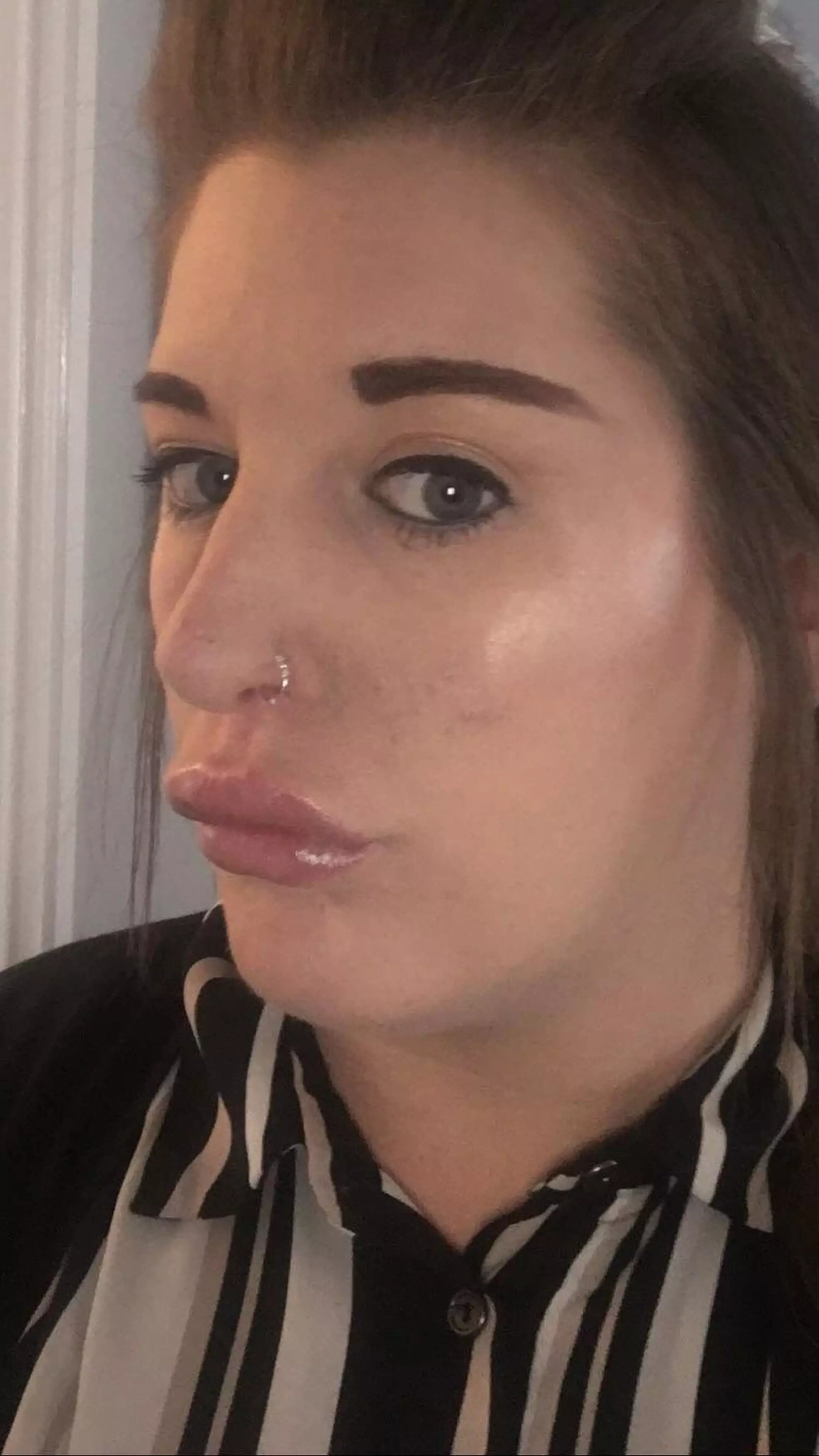 Kelly says she's scared to go out in public after the op left her with 'duck lips'.