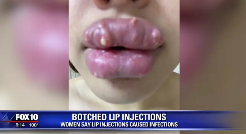 The women claim that the injections caused infection.