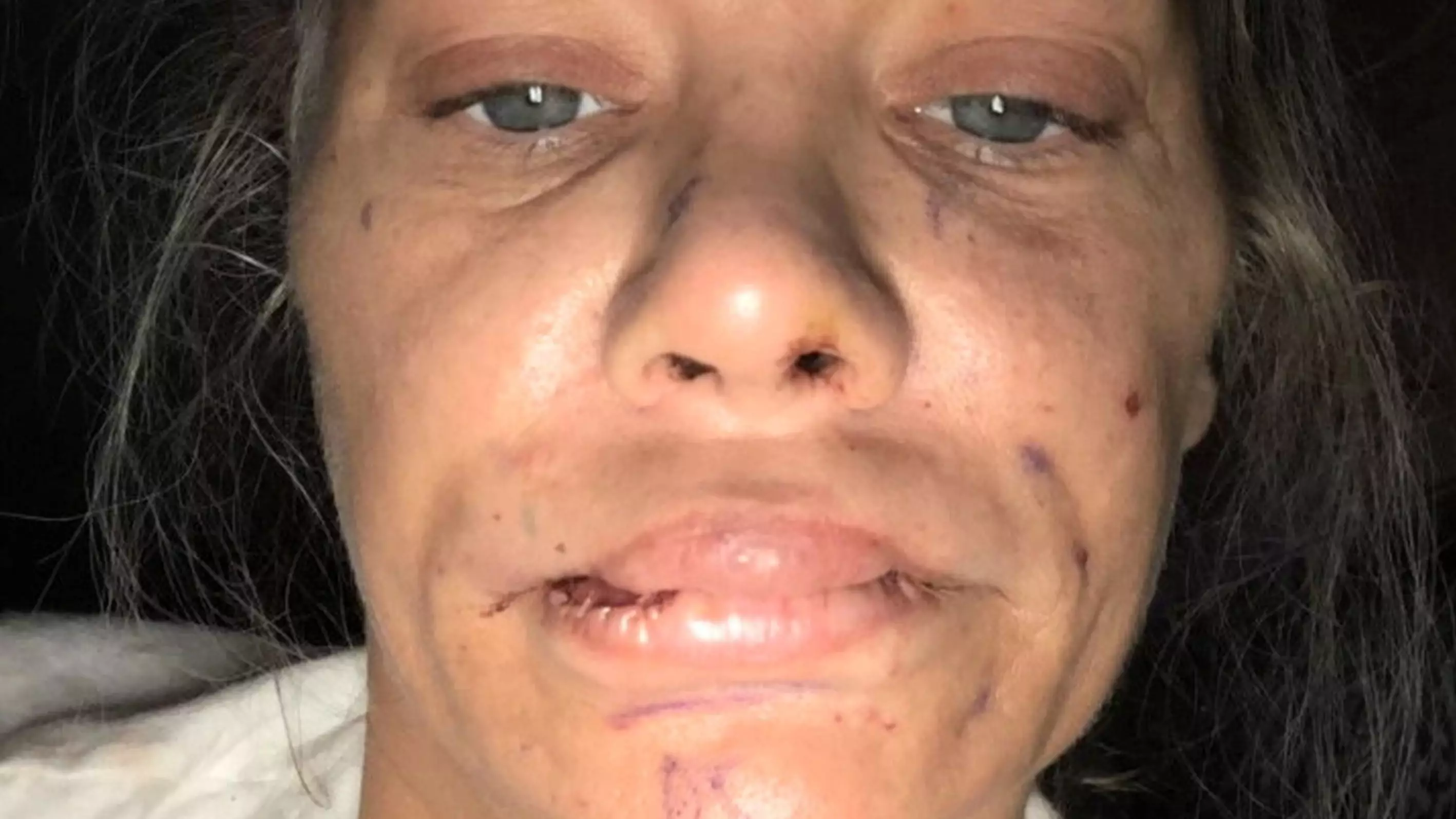Woman Left With Lumpy Lips And 'Piggy Snout' After Surgery Goes Wrong