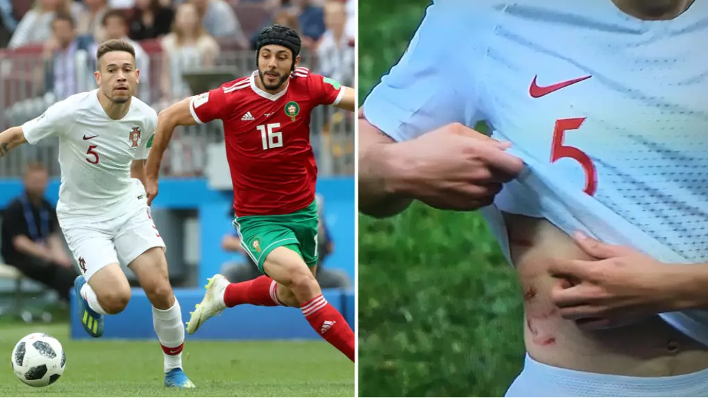 Raphaël Guerreiro Shows Off War Wounds After Tussle With Nordin Amrabat