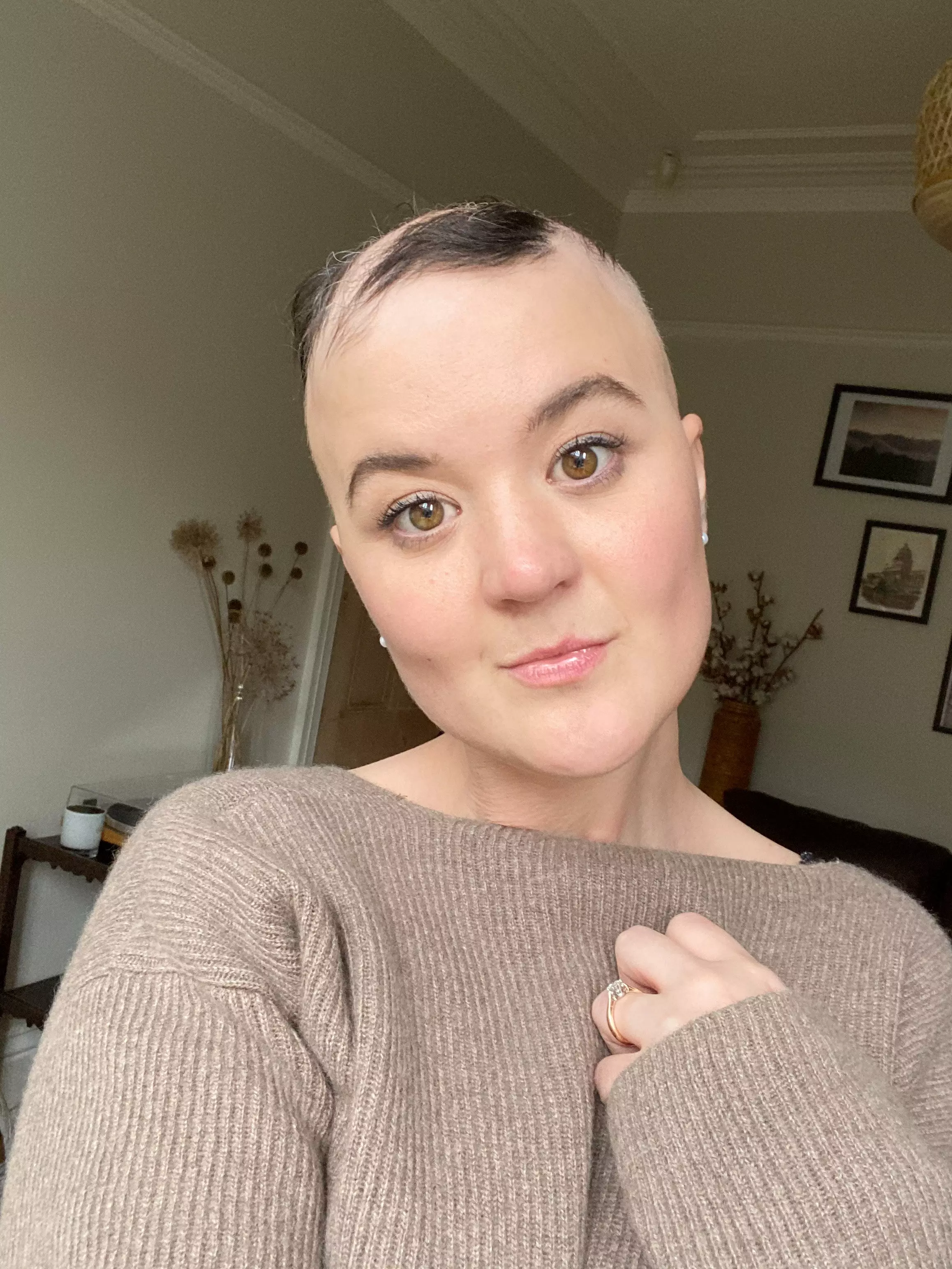 Hannah explained she was also shielding due to immunosuppressing medication taken to treat her alopecia (