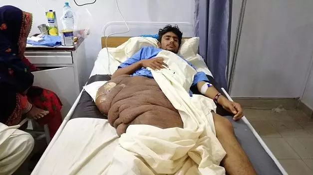 ​Teen Left Bedridden By 44lb Tumour Oh Thigh And Hip 