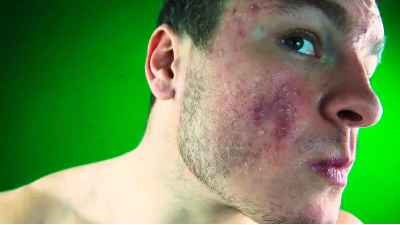 Bodybuilder With Acne Claims Giving Up Cheese Transformed His Skin