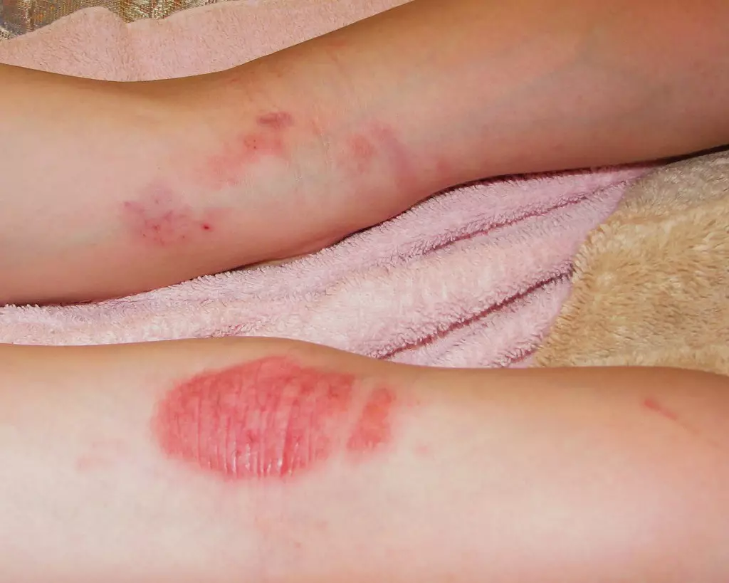 The medical condition comes in a variety of forms and atopic eczema (atopic dermatitis) is the most common type, causing skin to become dry, itchy, cracked and sore. (