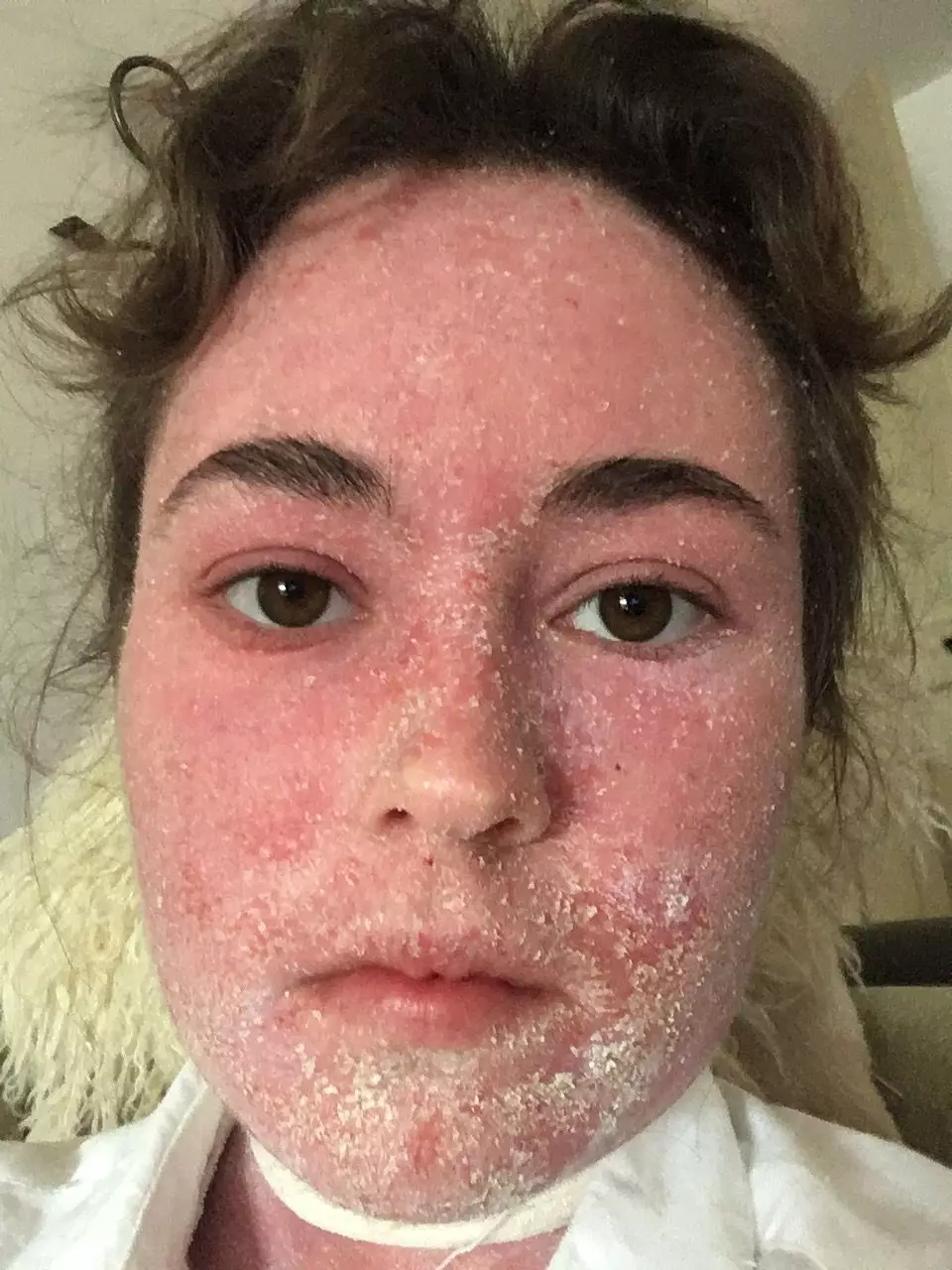 Holly's eczema has troubled her for years (