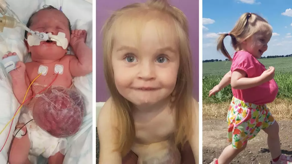 Two-Year-Old Toddler Born With Organs Outside Her Body Defies Odds After Fears She Wouldn't Survive Birth