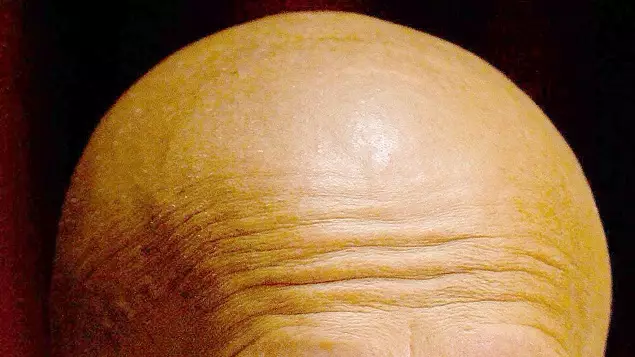 Potential Cure For Baldness Can Promote Hair Growth In Just Two Days