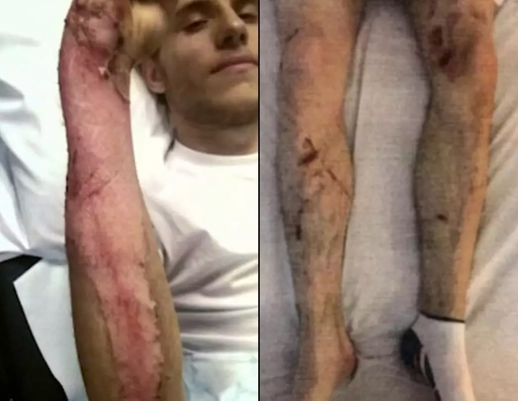 Alex with his burn injuries on his arm and the cuts on his legs.