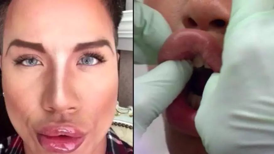 Man With Lips So Big He Can't Close His Mouth Wants More Injections