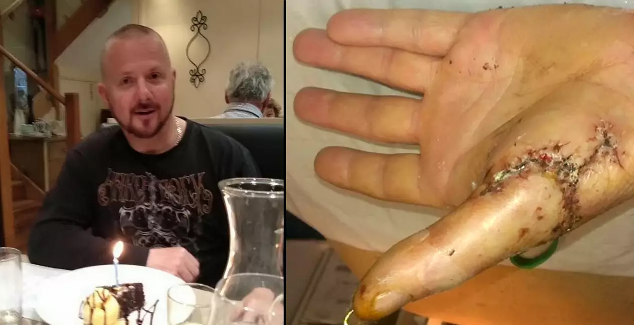Welder Shares Picture Of His Torn Thumb For Our Own Weird, Curious Benefit