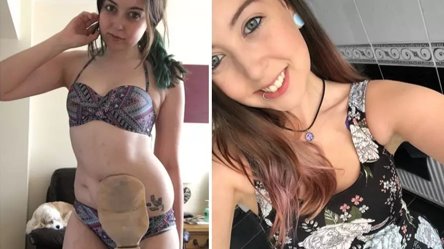 Woman Posts Inspiring Bikini Photo To Raise Awareness Of Crohn's Disease