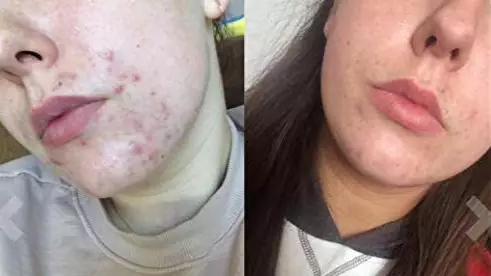 Women Are Praising This Miracle Serum That Makes Their Acne Disappear