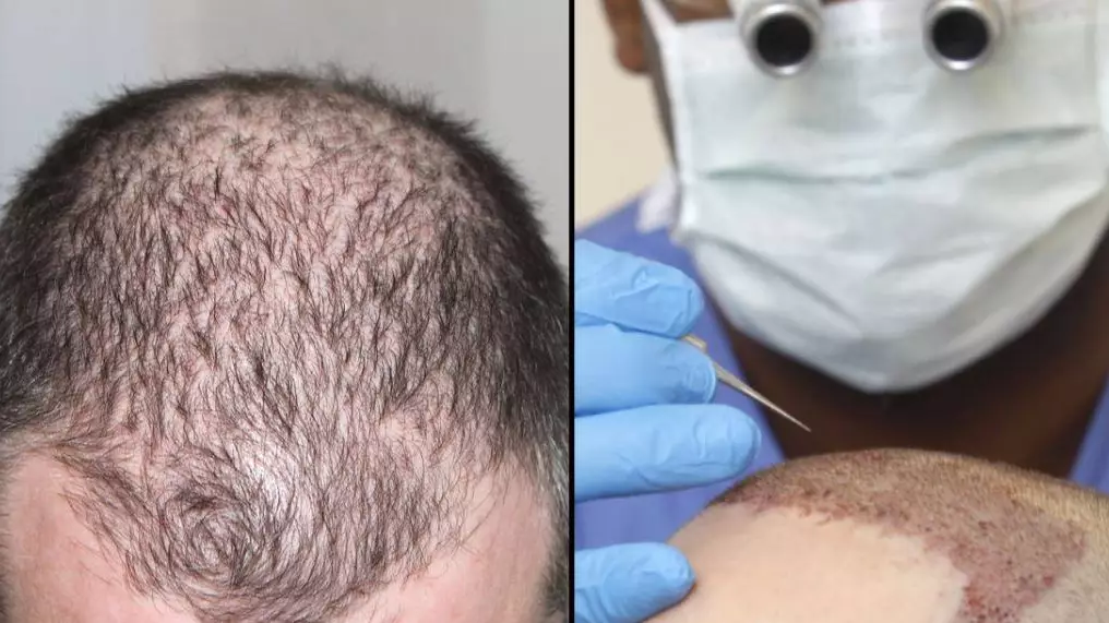 Man Dies From Suspected Allergic Reaction After 12-Hour Hair Transplant