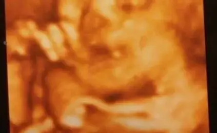 Proud Mum’s Ultrasound Of Her Unborn Baby Is Mistaken For A ‘Crisp Lasagne’