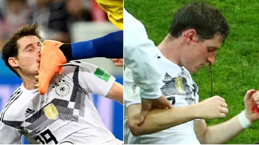 Germany's Sebastian Rudy Forced Off After Having His Nose Busted