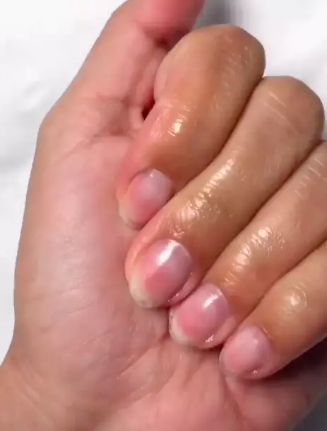 You can use cuticle oil or nail strengthener after removal (