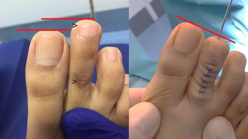 Toe Shortening Is A Thing And It's More Common Than You Think