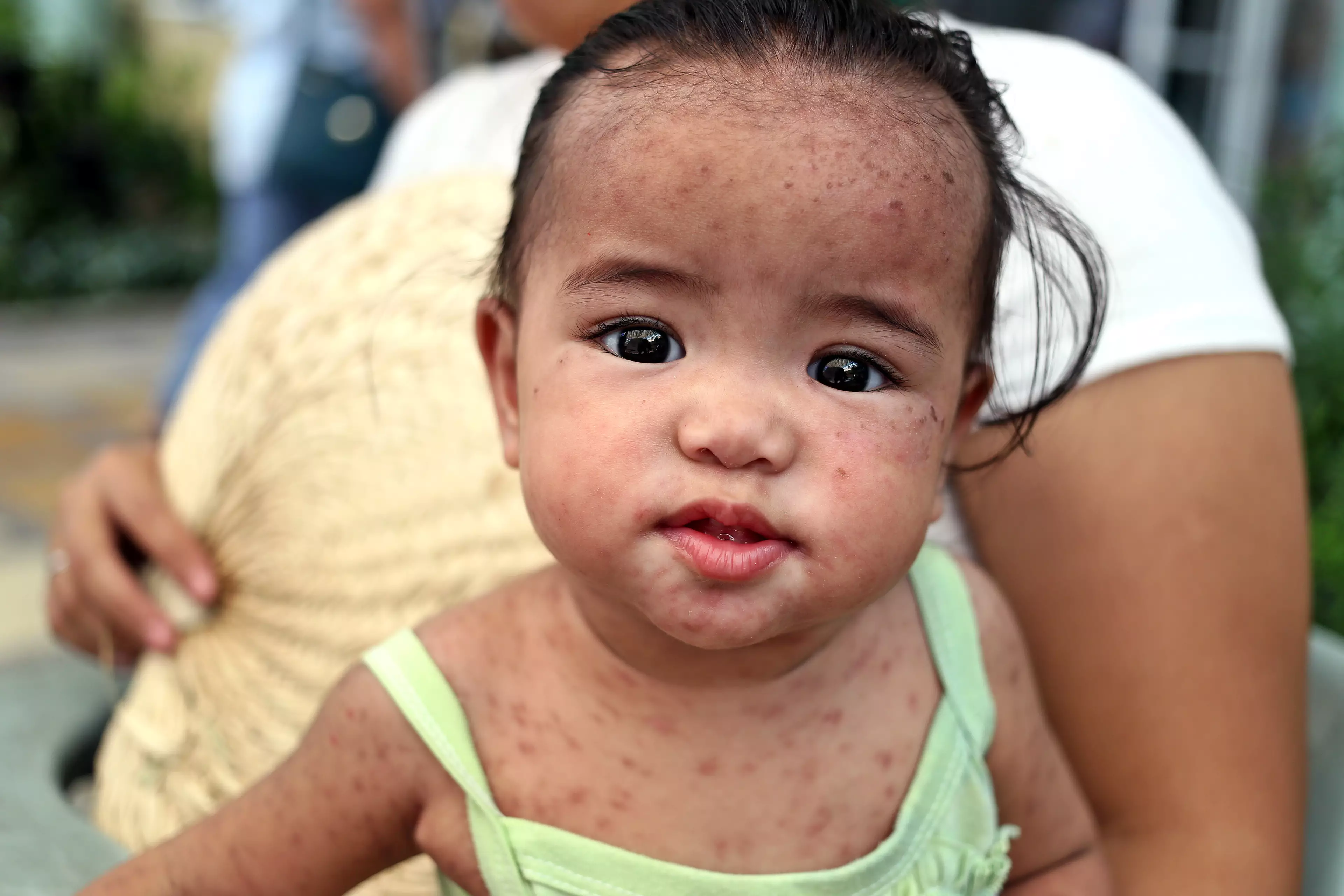 A child in the Philippines suffering from measles.