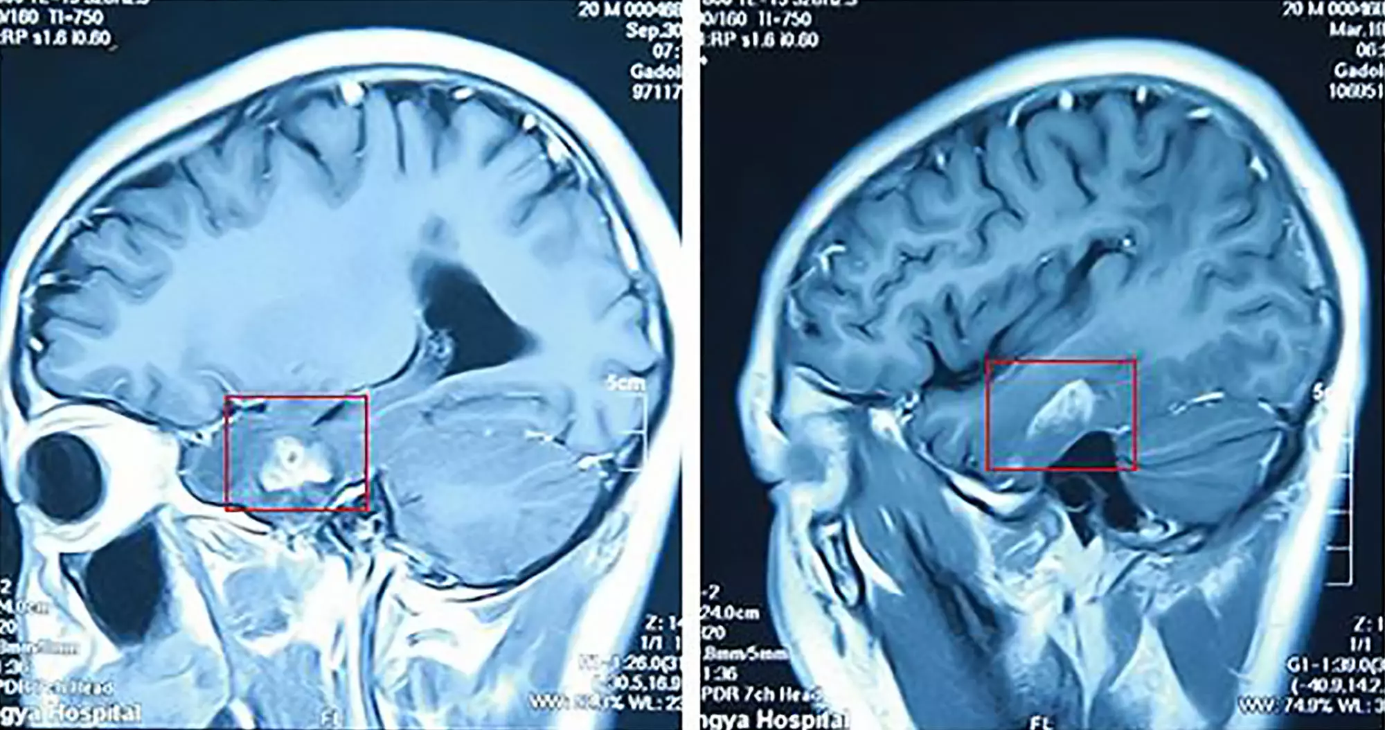 Doctors removed a four-inch-long parasitic tapeworm from this patient's brain.