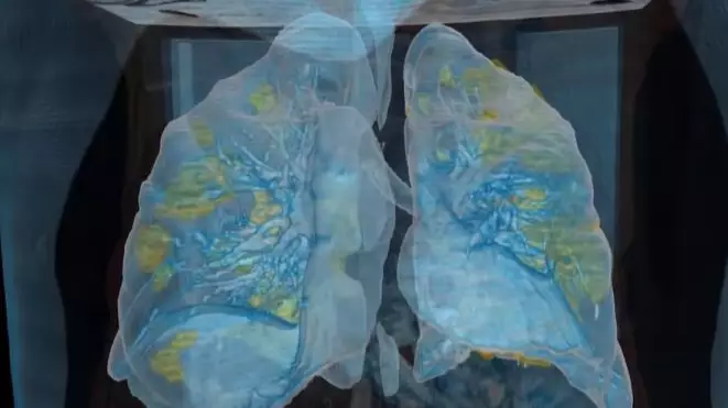 Video Shows The Devastating Effect Of Coronavirus On The Lungs