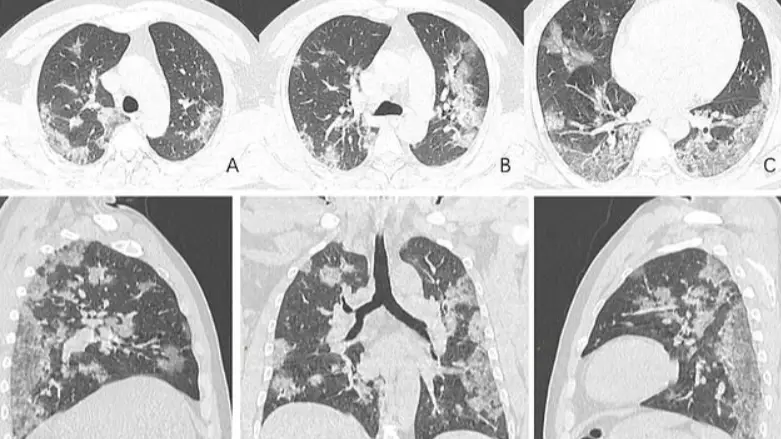 X-Ray Images Show The Damage Coronavirus Can Do To Lungs 