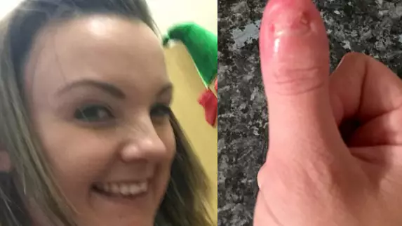 Woman Contracts Sepsis And Loses Tip Of Her Thumb After Removing Acrylic Nail 
