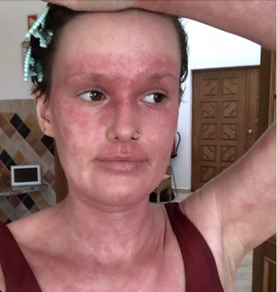 Alex was prescribed topical steroid creams by her GP to soothe the skin during her worst flare-ups (Media Drum World) 