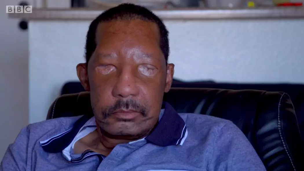 ​Man Speaks Out About Living With Stranger’s Face After Transplant