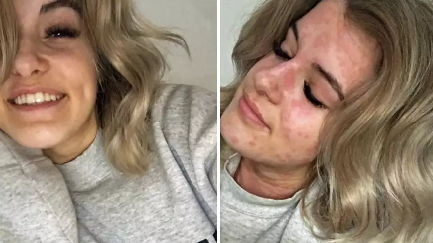 Meet The 21-Year-Old Woman Who Is Allergic To The Cold