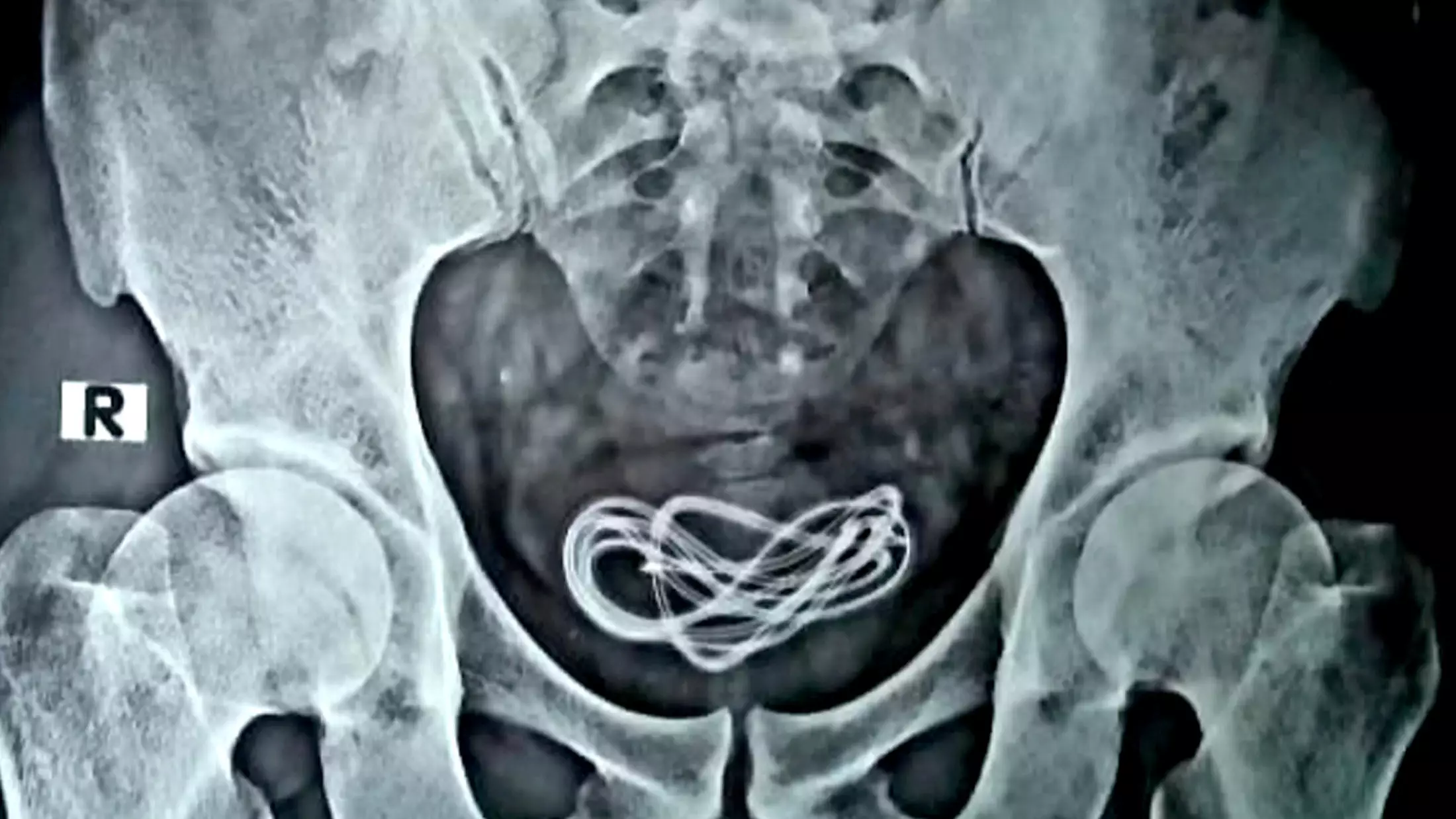 Doctors Remove Two Foot Long Charger Cable From Indian Man's Bladder 
