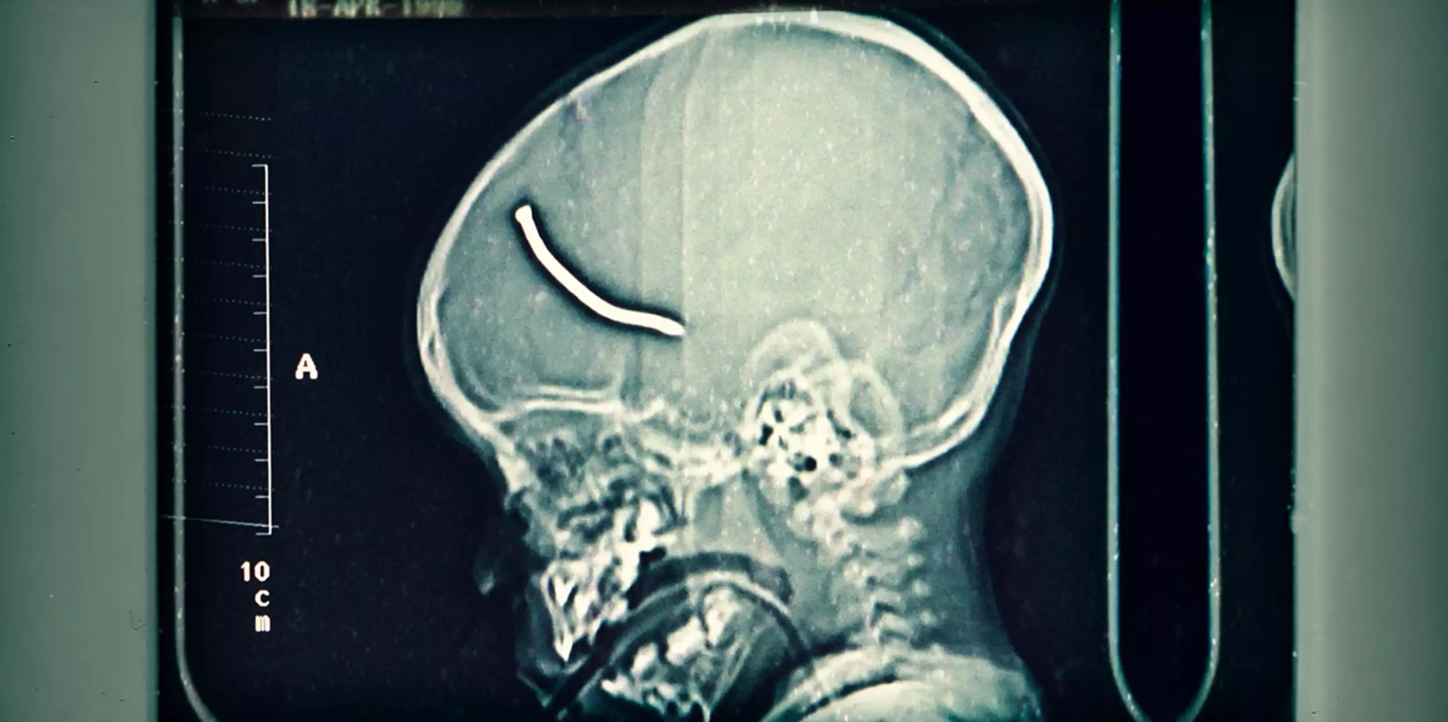 An unnamed child survived after a nail embedded in his brain after the Brixton bombing (