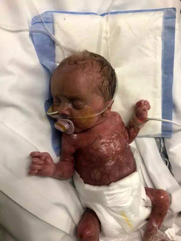 Kaiden was born with only 2 per cent of his skin.