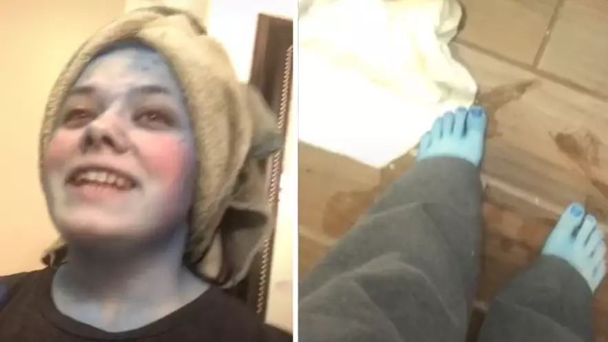 Woman Turns Blue After Attempting To Dye Her Hair