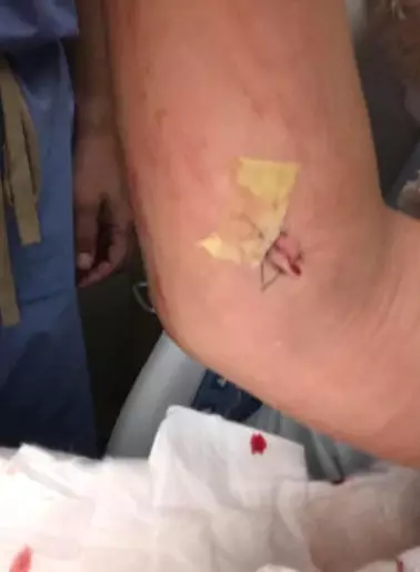 Hannah says she had to have plates and screws put into her arm.