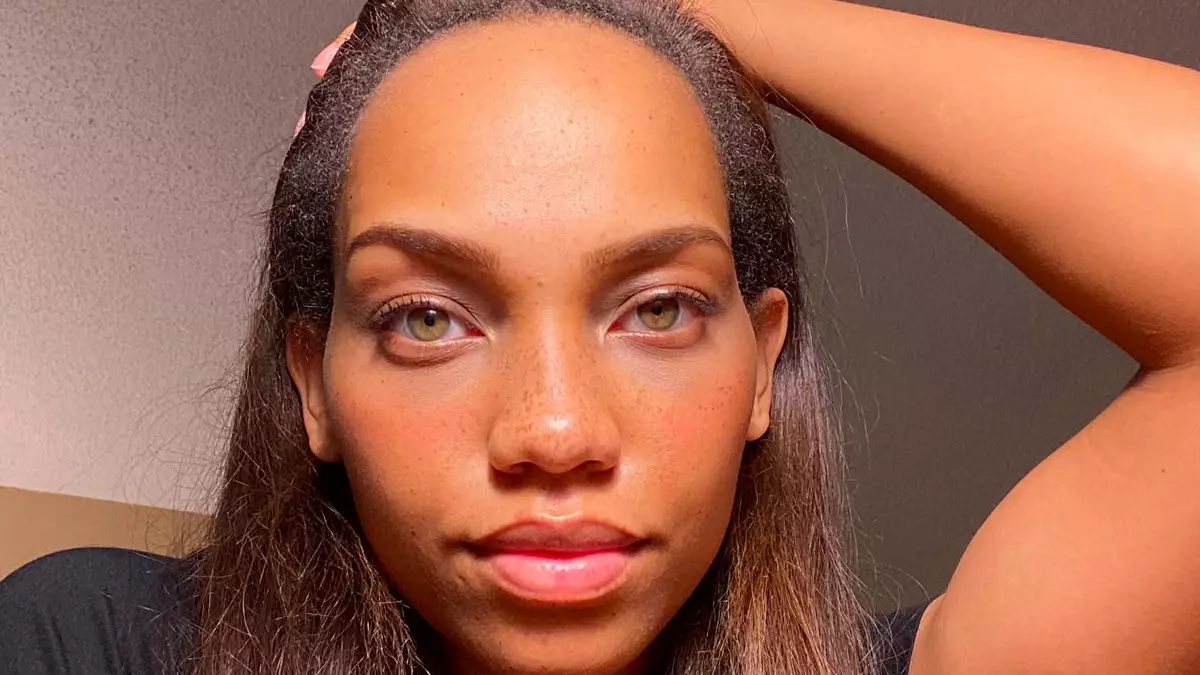 Model Pays £5,000 To Reduce Size Of Forehead By 3cm