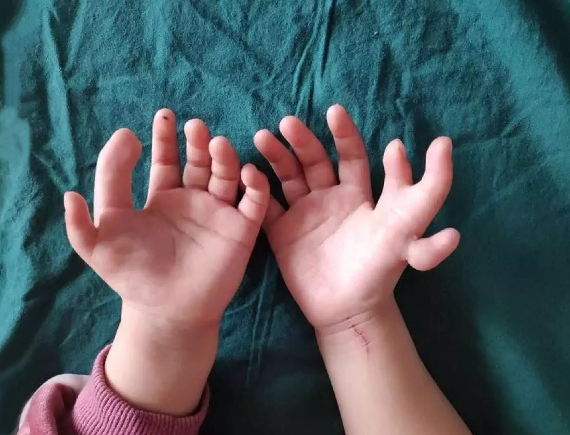 This three-year-old Chinese girl had 13 fingers.