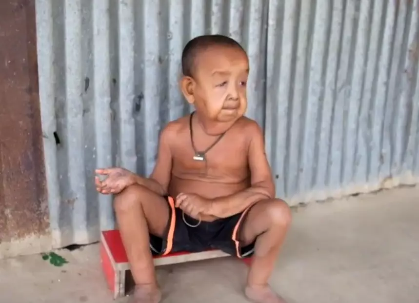 Meet The Four-Year-Old Boy Who Looks Like A Pensioner Due To Rare Condition