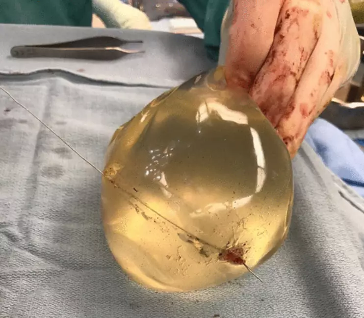 Doctors concluded that the implants most likely saved the woman's life.