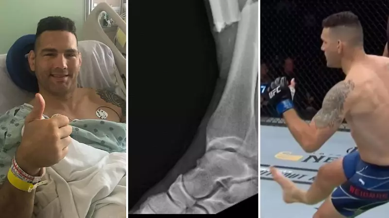 UFC Fighter Chris Weidman Posts Horrific Pre-Surgery X-Ray Images Of Double Leg Break Suffered At UFC 261